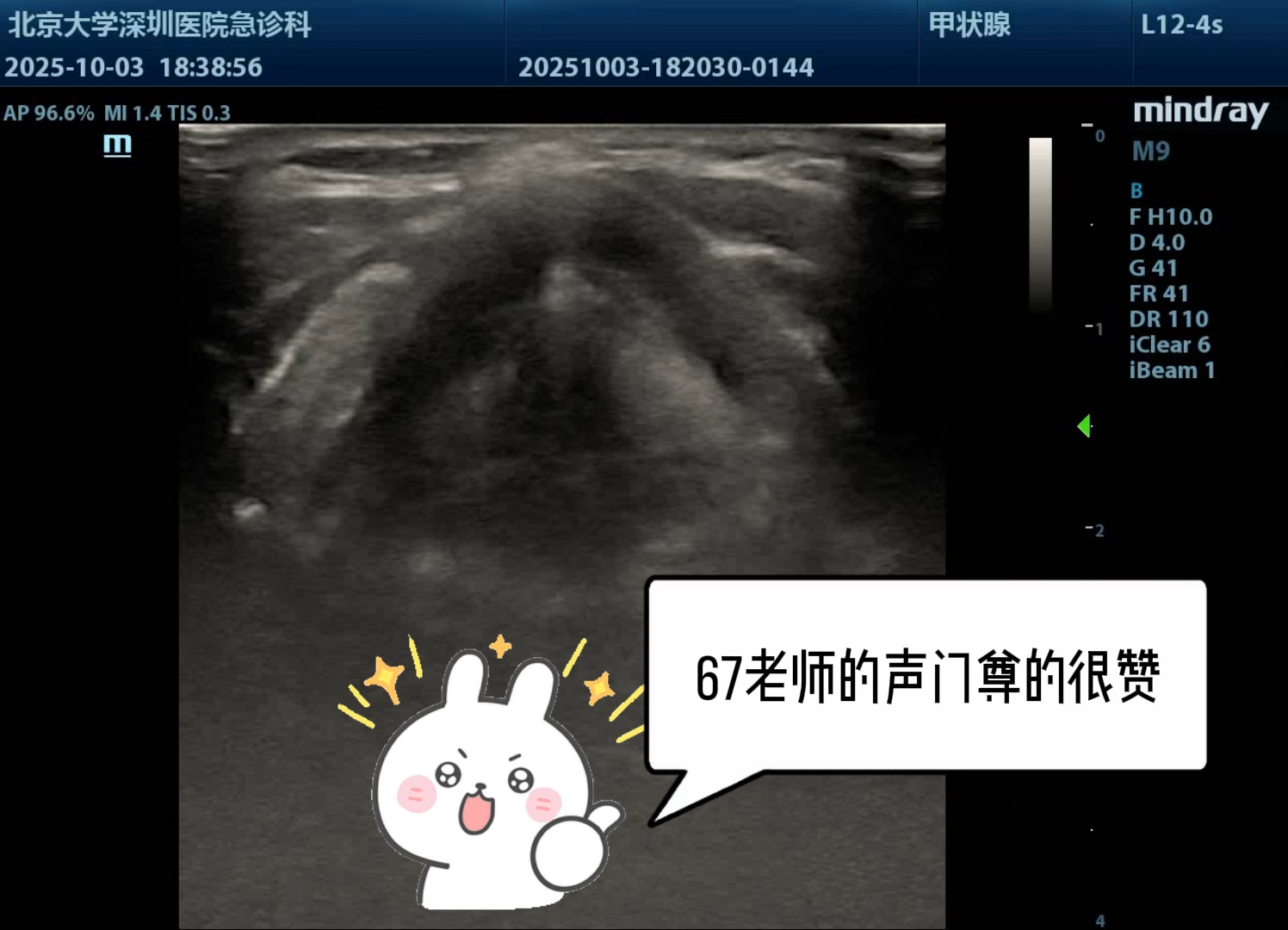 急诊超声 | 喉部超声扫查之声门超声