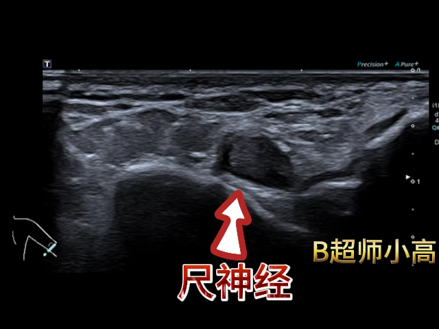 规培笔记尺神经间断脱位合并尺神经炎