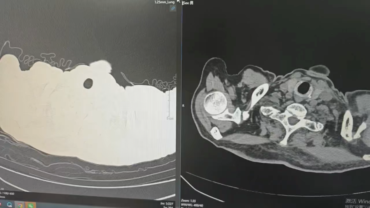 分享恶性胸腔积液病例
