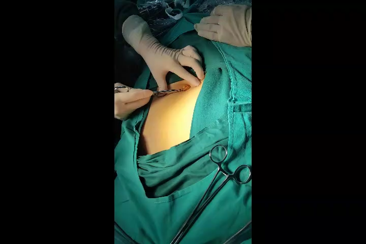 胆囊颈部结石嵌顿经脐单孔腹腔镜胆囊切除术一例分享