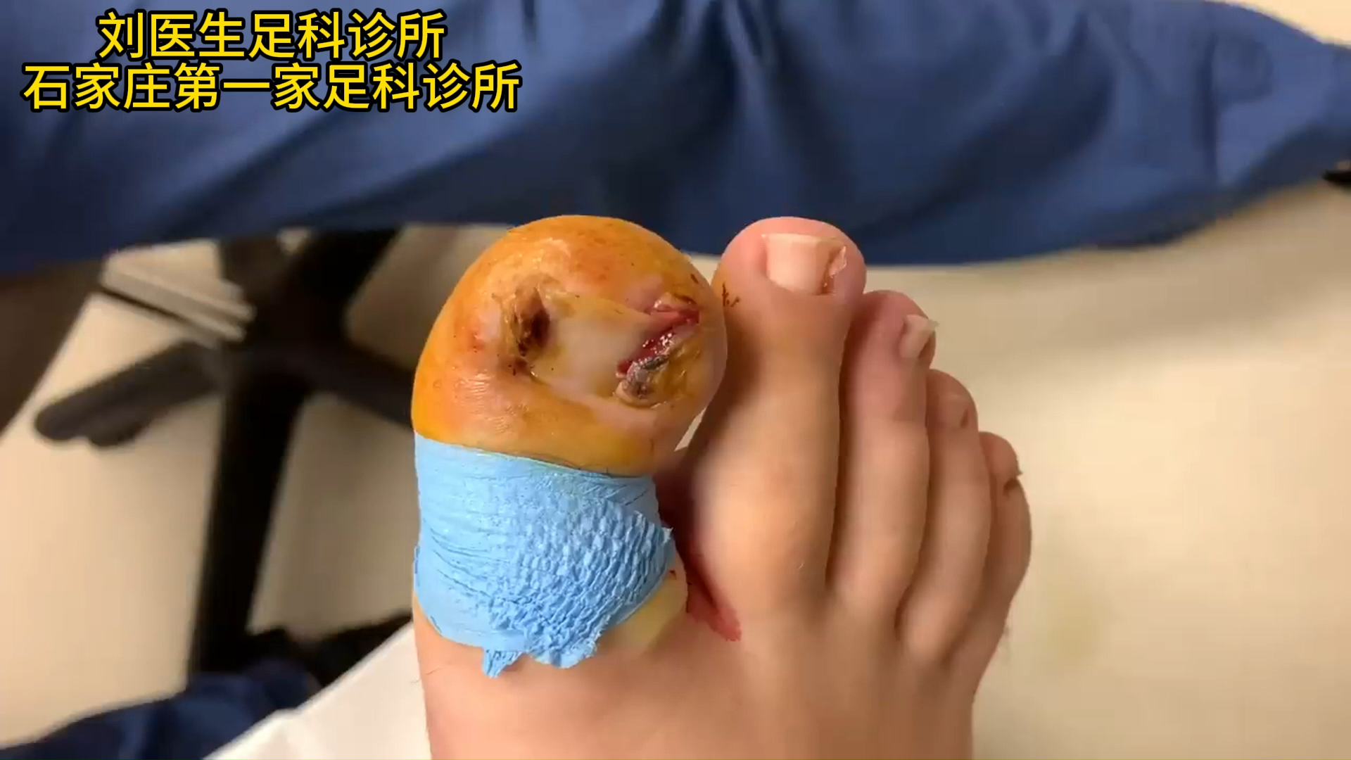 你知道外国人怎么治疗甲沟炎吗一篇文章告诉你附视频及文献原文