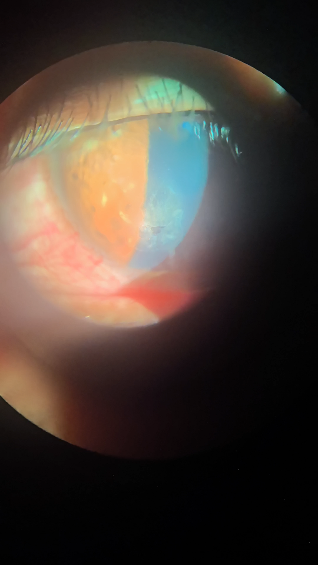 复发性角膜上皮糜烂