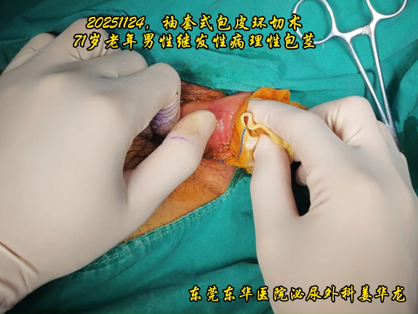 20251124袖套式包皮环切术,71岁老年男性继发性病理性包茎