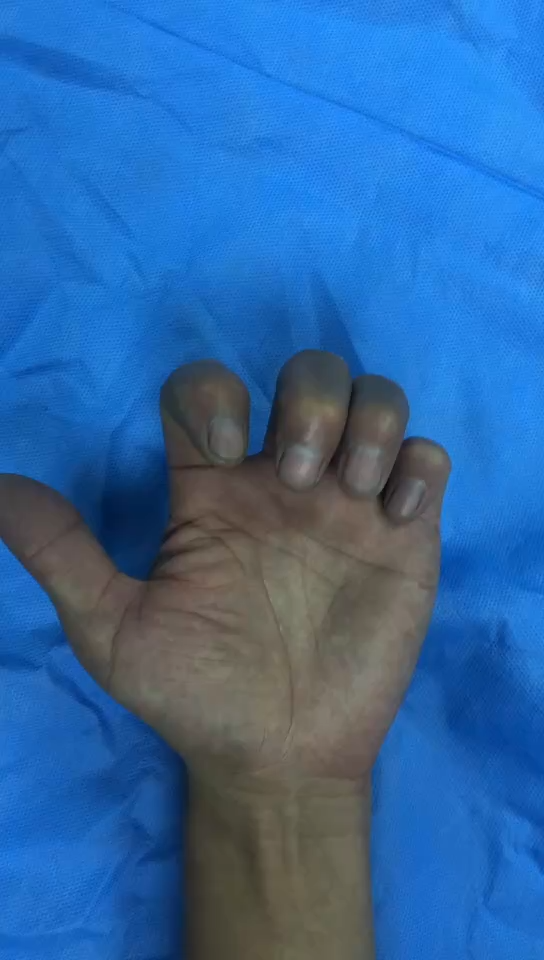 动力性外固定架治疗手指pip关节内骨折及脱位并伸肌腱止点撕脱性骨折