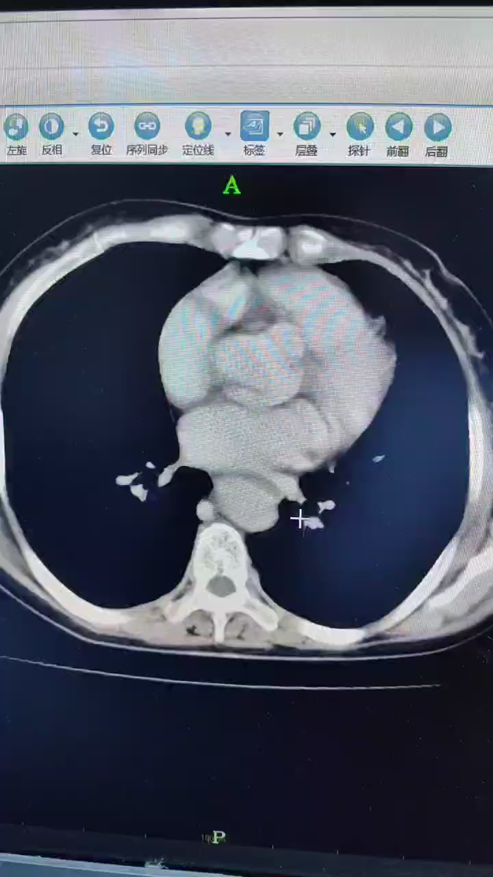 十二指肠乳头状腺癌1例