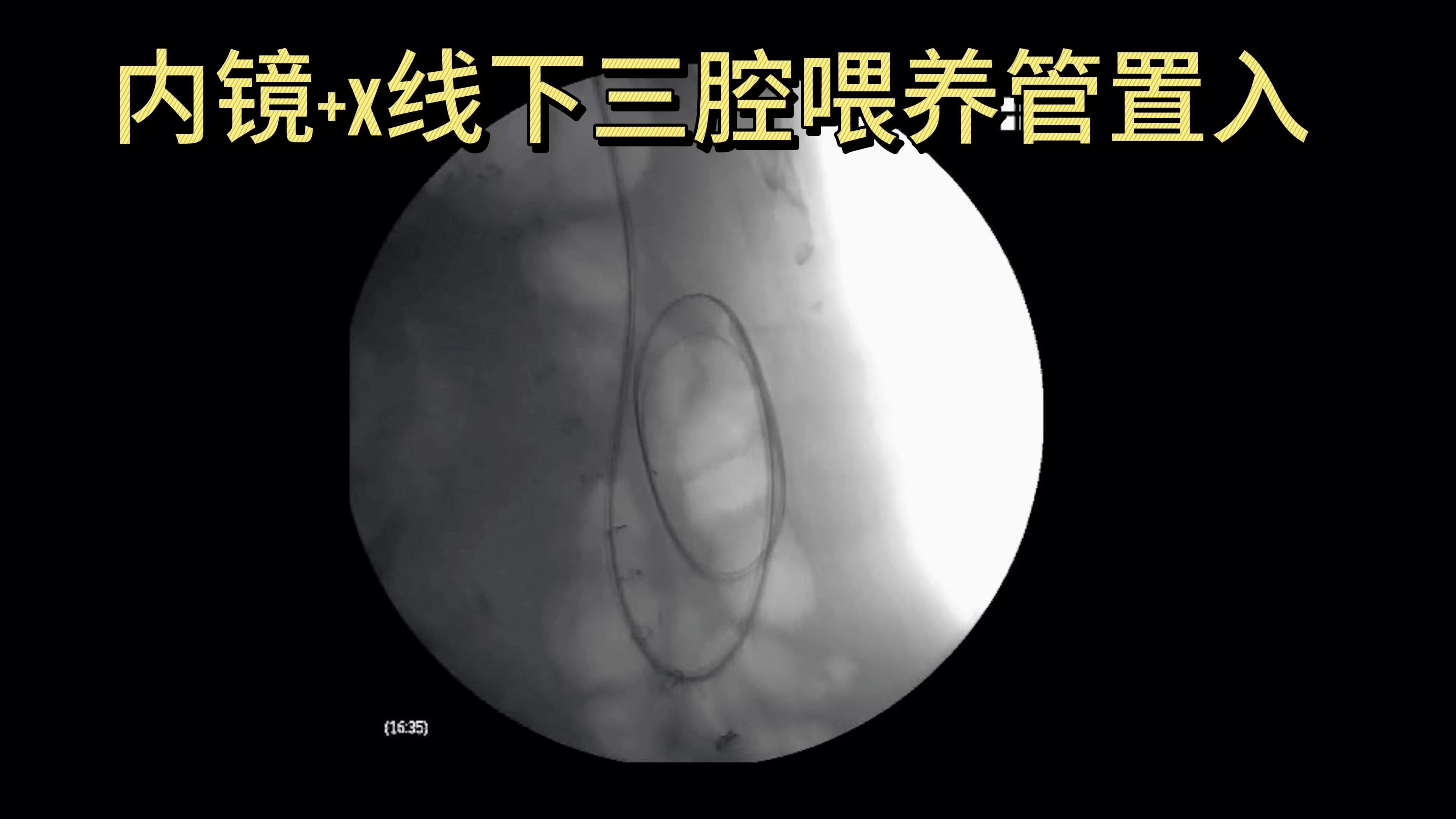 三腔喂养管图片