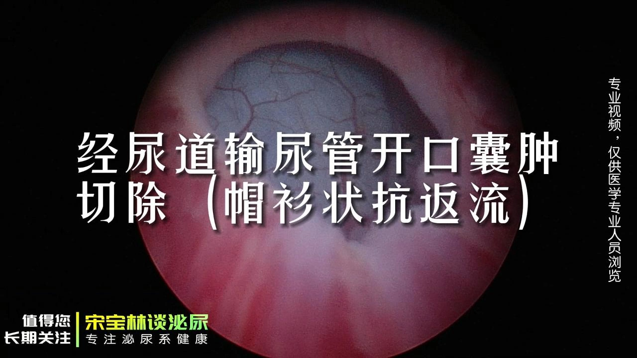 手术视频|经尿道输尿管开口囊肿切除(帽衫状抗返流)