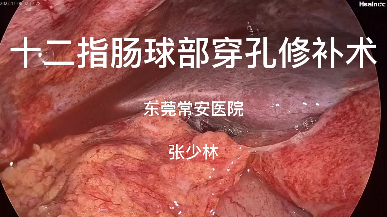 急诊十二指肠溃疡穿孔修补录像复盘