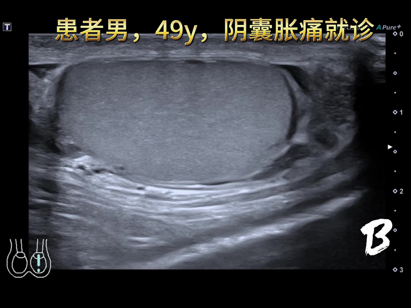 附睾头肿图片